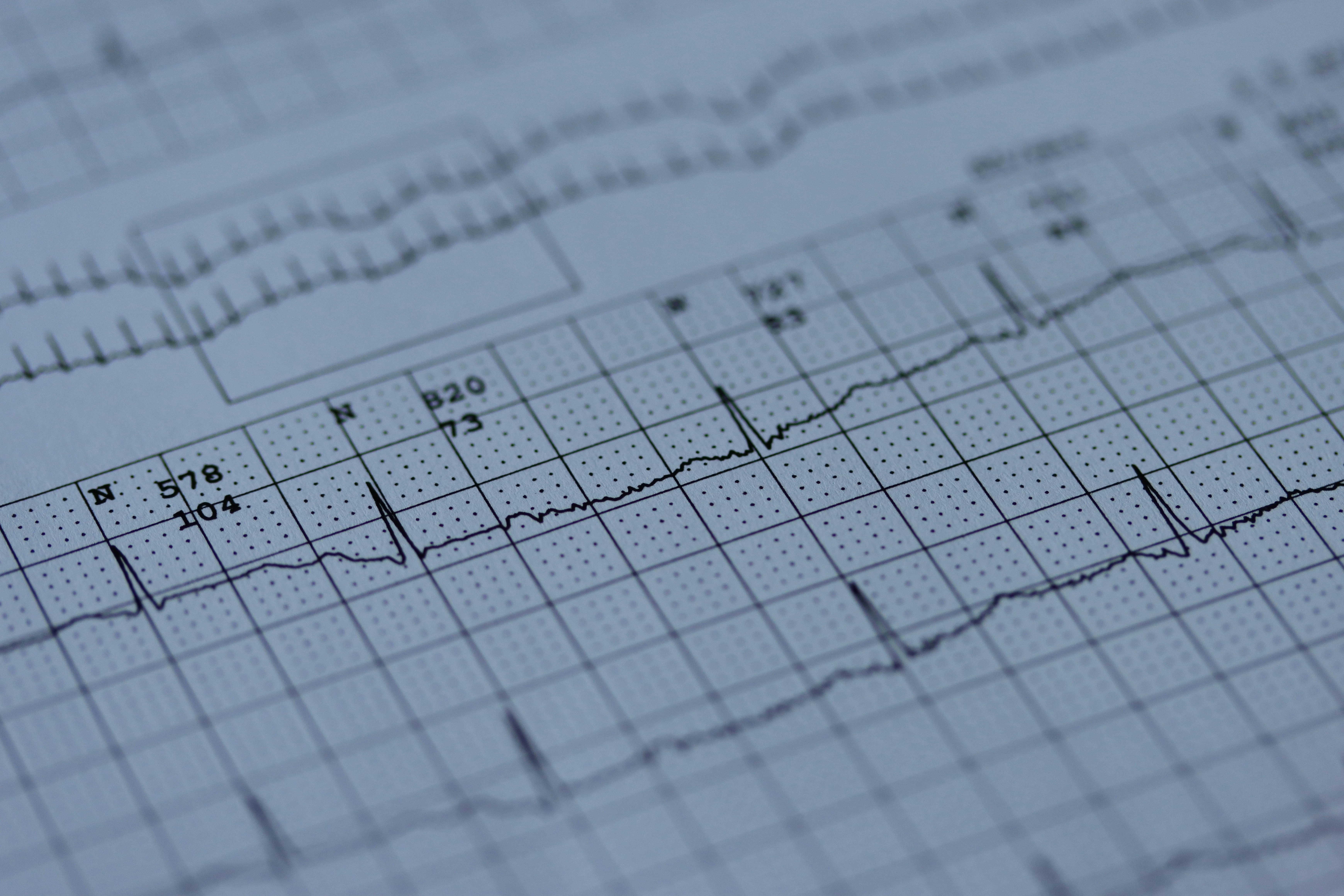 ECG / EKG sample